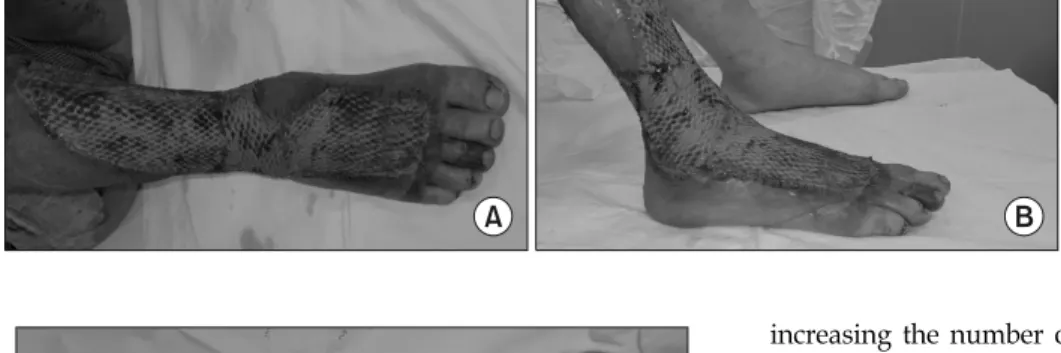 Fig. 4.  8  days  after  mesh  STSG  and  NPWT  images:  skin  graft  was  stable.