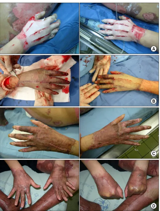 Fig. 1.  (A)  Full  thickness  burns  on  the  both  hands.  (B)  AlloDerm  and  sheet  graft  was  performed