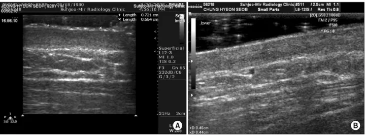 Fig. 1.  Sonography  showed  scar  height  is  thinner  from  0.8  mm  to  3.6  mm  compared  before  treatment  (A)  with  after  treatment  (B).