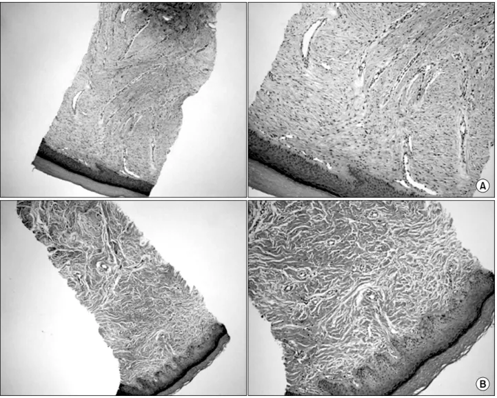 Fig. 2.  Sonography  results  showed  rete  ridge  recovery  in  epidermis  and  decrease  number  of  fibroblast  and  neovascularization  in  dermis  compared  before  treatment  (A)  with  after  treatment  (B).