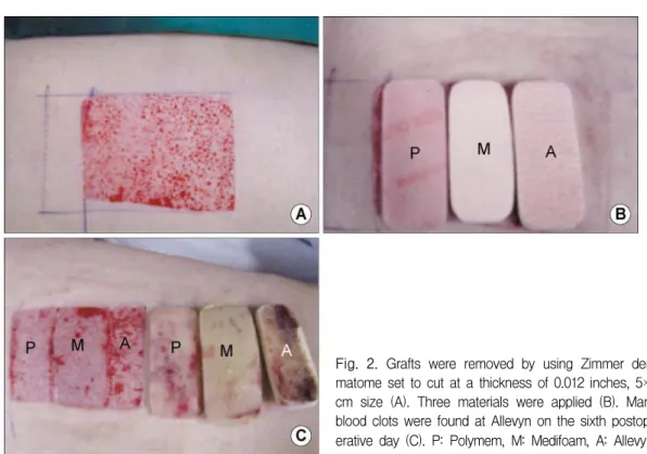 Fig.  2.  Grafts  were  removed  by  using  Zimmer  der- der-matome  set  to  cut  at  a  thickness  of  0.012  inches,  5×6  cm  size  (A)