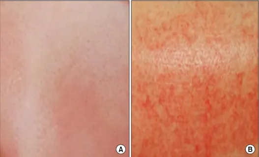 Fig. 2.  (A)  This  photo  shows  pale  color  on  deep  second  degree  burn. 
