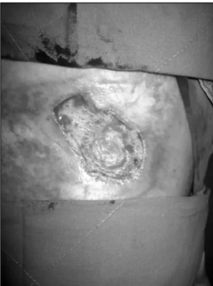 Fig. 1.  Ulceration  was  present  on  the  pad  site  with  surrounding  scar. 