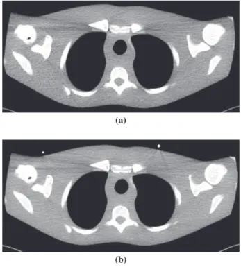 Fig. 3.   Low dose CT with CARE Dose 4D (a) and fixed tube cur-