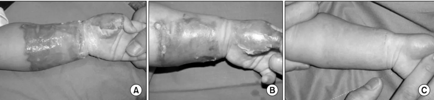 Fig. 1.  (A)  This  8  month-old  male  patient  suffered  from  scalding  burn,  mid  2nd  degree  on  his  both  dorsum  of  foot  on  April  21th  2006
