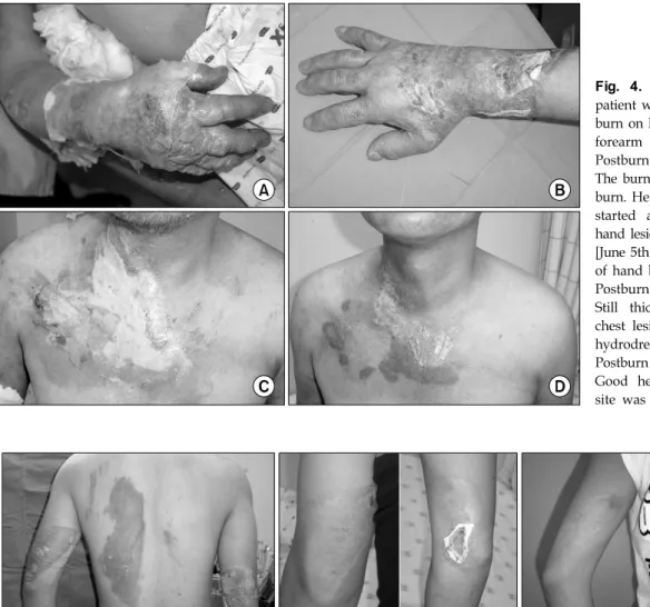 Fig. 5. (A)  The  27  year-old  male  sustained  from  mid  second  degree,  electric  flash  burn  on  his  both  upper  arms  and  back  on  June  2nd