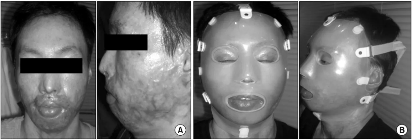 Fig. 2.  Facial  silicone  mask  was  applied  on  burn  scar  lesion,  severe  elevated  scar  on  perioral  area