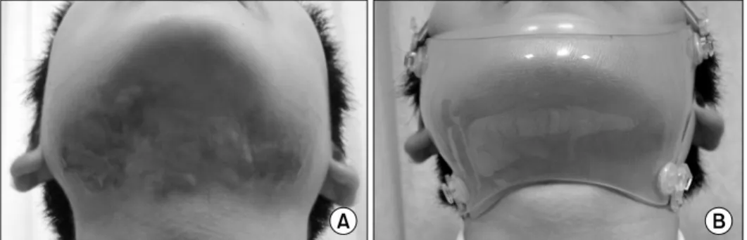 Fig. 5.    M/15,  flame  burn,  post  burn  3  month,  skin  graft  state.  (A)  Before,  (B)  After  splint  application,  corrective  device  was  added  to  anterior  neck  support.