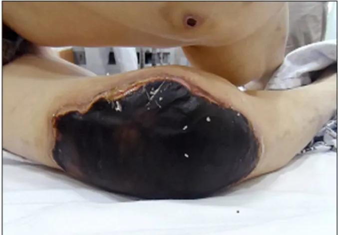Fig. 1.  This  photo  shows  20×30  cm 2   sized  eschar  on  right  knee. Fig. 2.  Burn  involves  medulla  of  patella