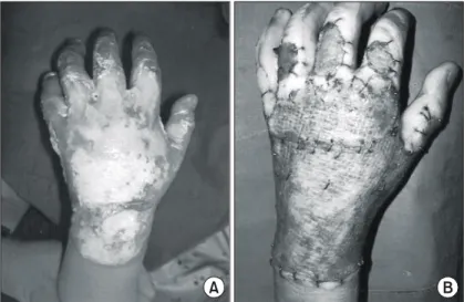 Fig.  3.  A  10  years  old  female  patient  with  mid  second  degree  burn  on  her  face.