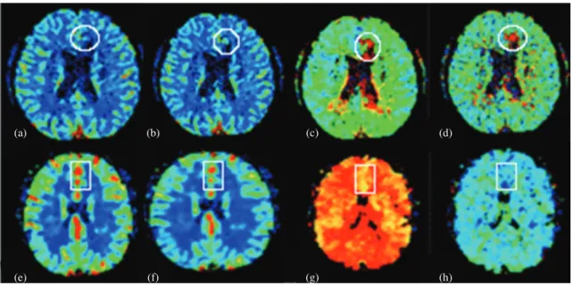 Fig. 5.   Perfusion MRI of an 54-year-old man with hyper-acute stroke on 1.5 T (a, b, c, d) and 3.0 T (e, f, g, h)
