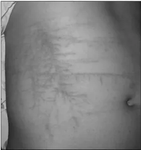 Fig. 2.  Increased  uptake  on  the  left  lateral  of  6th  rib  by  3  phase  bone  scan.