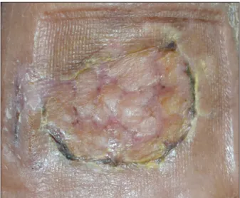Fig. 6.  Complete  healing  on  day  6  after  surgery  (recipient  site).