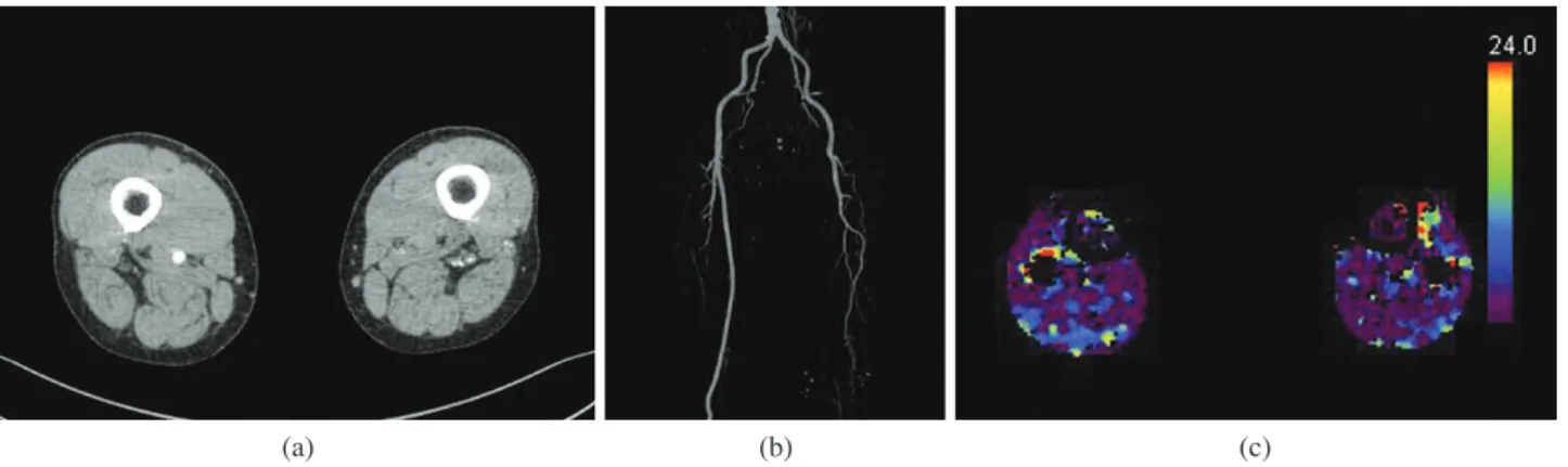 Fig. 3. (a) Axial image of lower extremity CTA (b) MIP image of lower extremity CTA (c) Color map image of blood flow.