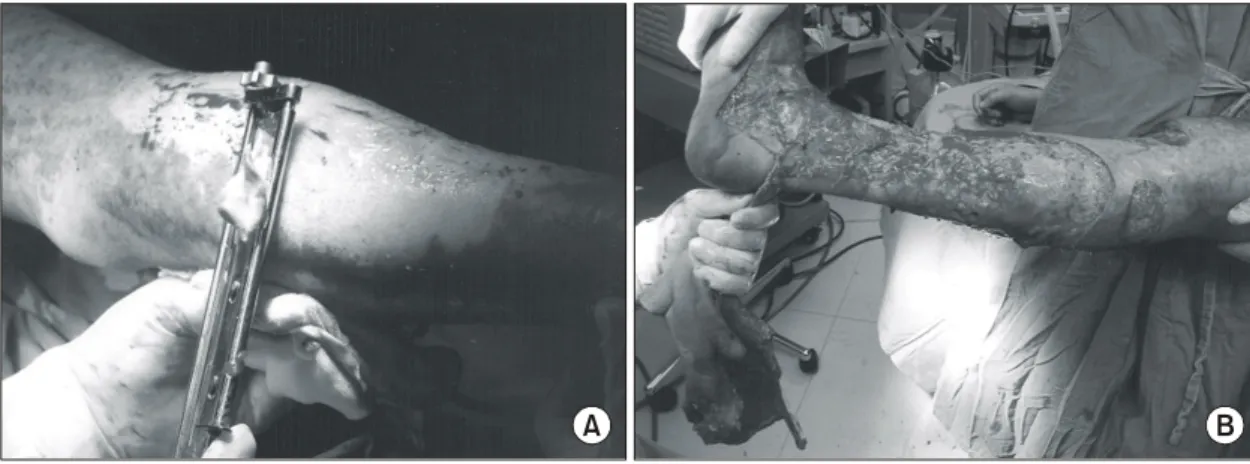 Fig.  1.  Selective  Escharectomy  was  performed  for  full  thickness  burn  areas  and,  if  possible,  within  72  hours  of  the  actual  burn