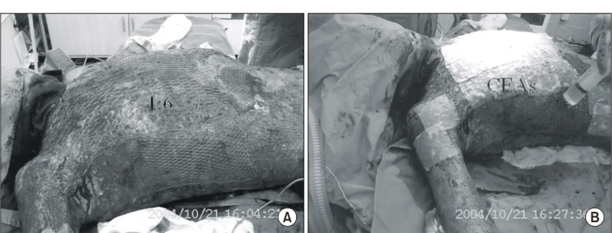 Fig.  5.  (A,  B)  Acellular  dermal  substitute  (AlloDerm)  was  concurrently  used  in  6  cases  to  prevent  scar  contraction  on  the  joint  areas