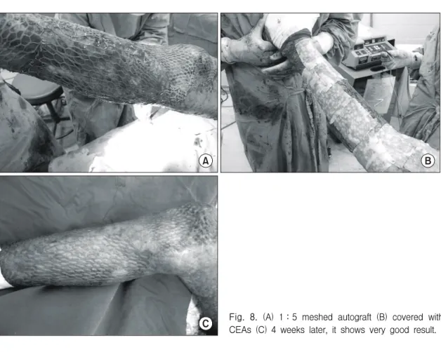 Fig.  8.  (A)  1：5  meshed  autograft  (B)  covered  with  CEAs  (C)  4  weeks  later,  it  shows  very  good  result