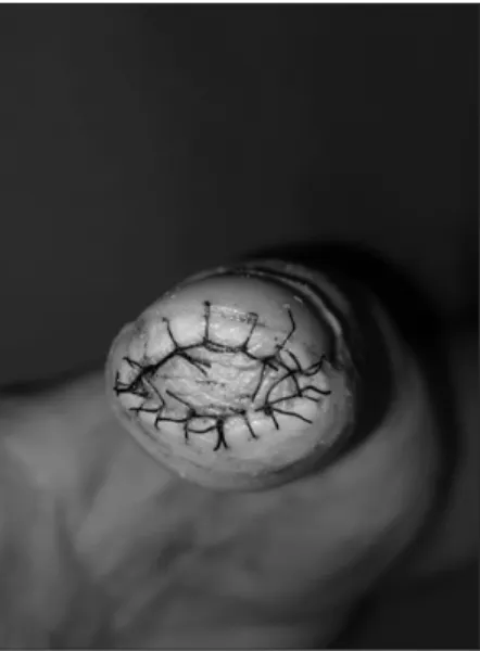 Fig. 7.  On  postoperative  day  3,  the  well-taken  graft  was  noted. 