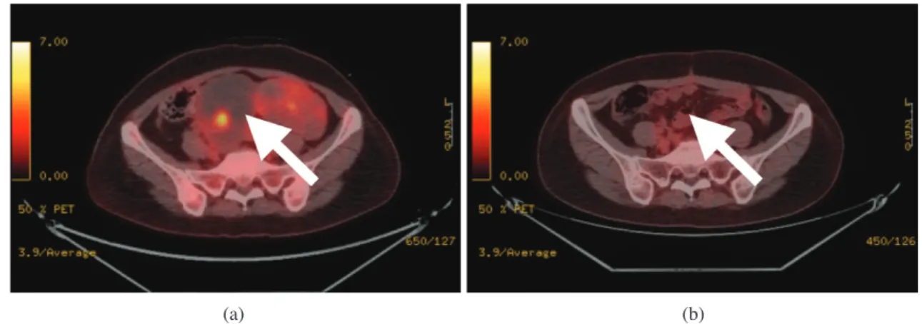 Fig. 6. Before treatment of the Breast ca patient (a) and after (b) image.(a) (b)