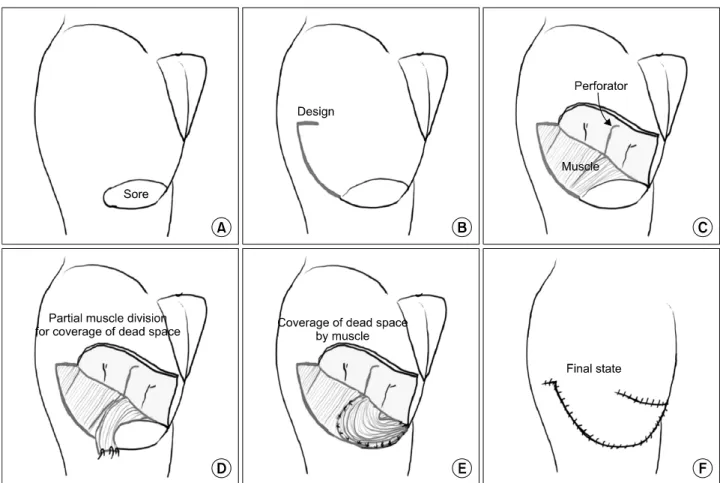 Fig. 3.  Schematic  illustration  of  the  operation  technique  of  the  perforator-sparing  and  rotation-advancement  flap  with  V-Y  closure  in  the  management  of  an  ischial  pressure  sore