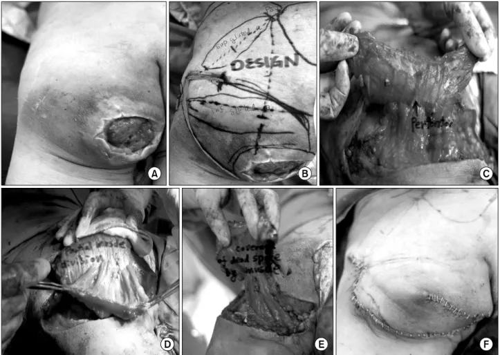 Fig. 4.  Clinical  application  of  the  operation  technique  of  the  perforator-sparing  and  rotation-advancement  flap  with  V-Y  closure  in  the  management  of  an  ischial  pressure  sore  of  clinical  case  3