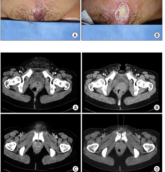 Fig. 2. (A)  The  APCT  on  4  weeks  postburn  showed  diffuse  fatty   infil-tration  at  the  lower  abdominal  wall