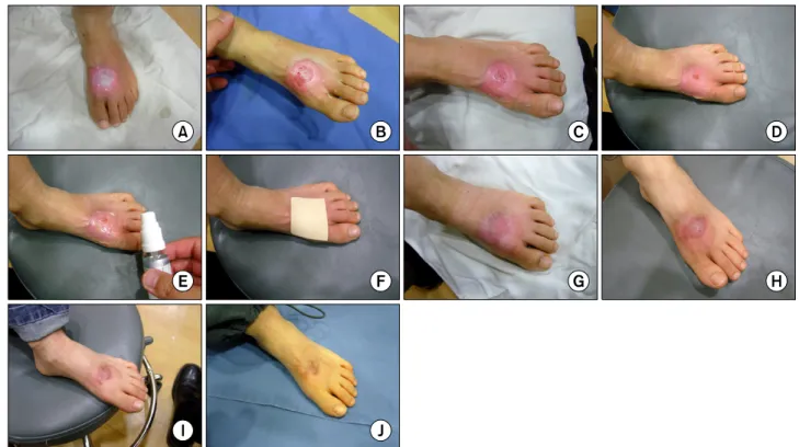 Fig. 1. Clinical  case,  scalding  burn  1%  TBSA,  male,  8  yrs  old.  (A)  Post-burn  11  day,  (B)  Post-burn  18  day,  (C)  Post-burn  23  day,  (D)  Post-burn  30  day,  (E)  Easyef Ⓡ   spray,  (F)  Medifoam Ⓡ  dressing,  (G)  Post-burn  44  day  (c