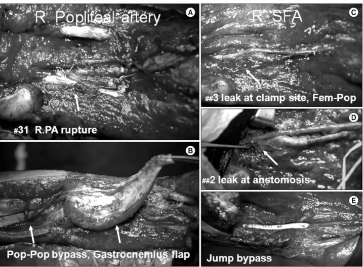 Fig. 4.  Iatrogenic  rupture  (G2-8,  G3-1);  (A)  The  right  Popliteal  artery  ruptured  at  2  cm  proximal  to  burned  eschar  margin  on  the  31th  post  burn  day  by  inflammation