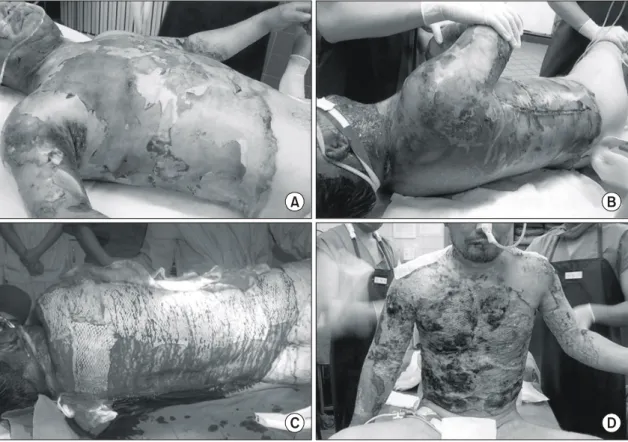 Fig.  1.  (A,B)  42  years  old  man  with  42%TBSA  of  flame  burn  at  initial  burn  day,  (C)  The  excised  wounds  were  covered  with  CPA,  40%TBSA,  (D)  CPA  completely  took  on  the  wounds.