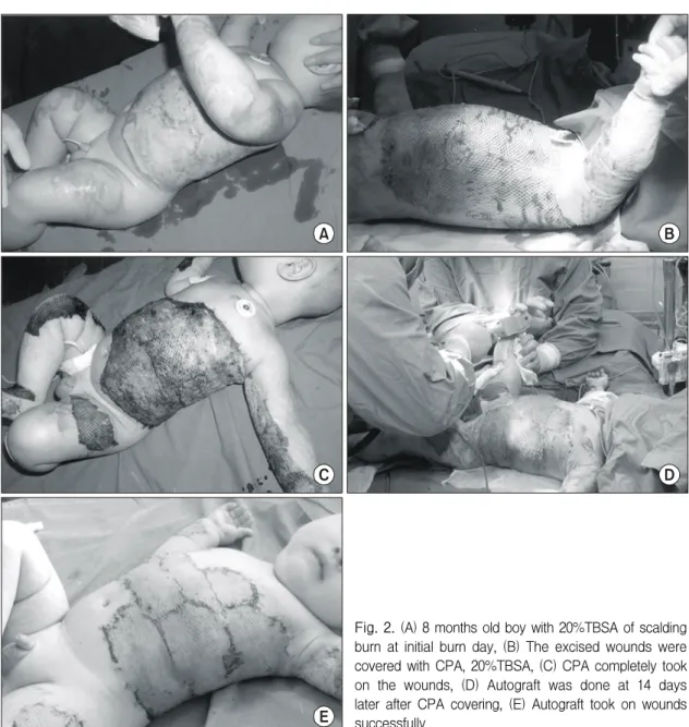 Fig.  2.  (A)  8  months  old  boy  with  20%TBSA  of  scalding  burn  at  initial  burn  day,  (B)  The  excised  wounds  were  covered  with  CPA,  20%TBSA,  (C)  CPA  completely  took  on  the  wounds,  (D)  Autograft  was  done  at  14  days  later  af