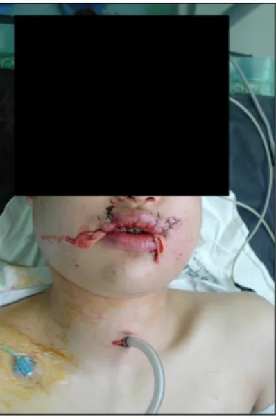 Fig. 1.  The  18-year-old  male  patient  had  firework  explosion  injury.  Multiple  lip  lacerations  and  facial  swelling  was  shown  at  preoperative  state.
