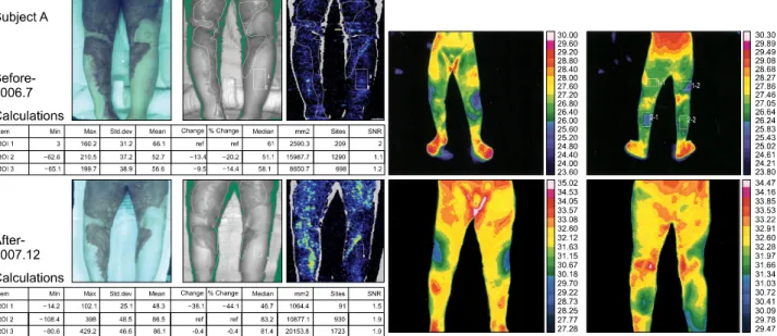 Fig. 1.  Data  of  LASER  DOPPLER  (right)  and  Thermography  (left)  show  that  blood  perfusion  of  burn  wounds  was  increased