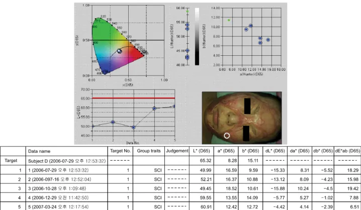 Fig. 5.  In  measurement  by  spectrophotometer  color  of  burn  wound  on  face  approached  to  normal  state  nine  months  after  SRMT