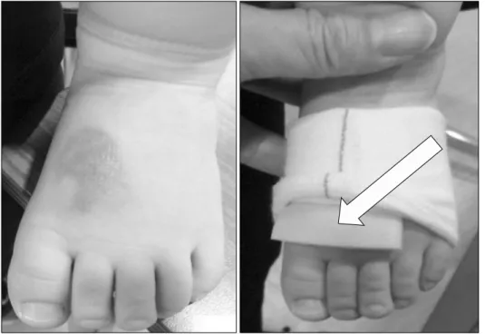 Fig. 7.  Photograph  of  spongy  adding  under  the  two  layer  of  tubular  compressive  bandage  (TCB; 