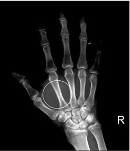 Fig. 3.  Intraoperative  photograph  shows  soft  tissue  mass  that  is  attached  to  flexor  tendon  sheath  of  right  hand.