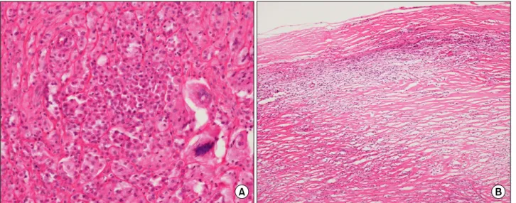 Fig. 5.  (A)  In  microscopic  histologic  view  (magnified  ×200),  scattered  multinucleated  giant  cells  are  present  with  cluster  of  lipid  laden  cells