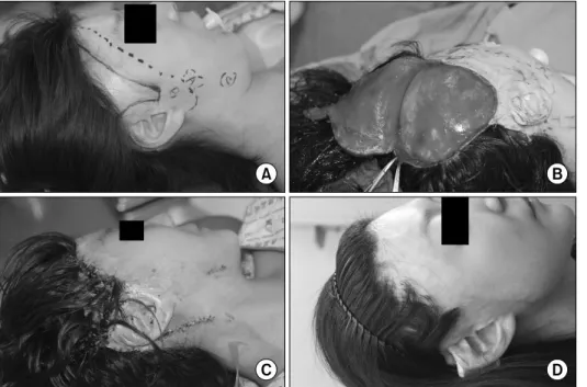 Fig. 2.  (A)  Preoperative.  The  31  year-old  female  patient  suffered  from  the  loss  of  right  sideburn  and  frontal  hairline  with  burn  scars  after  flame  burn