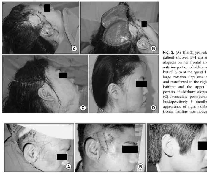 Fig. 4.  (A)  Preoperative.  The  22  year-old  male  patient  sustained  from  the  flame  burn,  he  showed  the  loss  of  hairline  and  sideburn  with  burn  scars  on  his  right  face