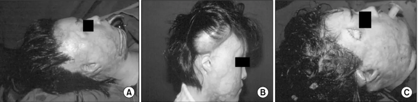 Fig. 5.  (A)  This  13  year-old  female  patient  suffered  from  diffuse  alopecia  on  her  right  sideburn  and  frontal  hairline  caused  by  flame  burn  in  childhood