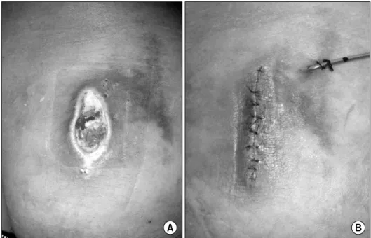 Fig. 6.  A  53-year-old  male  with  3rd  degree  burn  on  his  right  buttock  (A).  We  debrided  his  eschar  (B)  and  performed  a  split-thickness  skin  graft  with  Matriderm ⓡ   (B).
