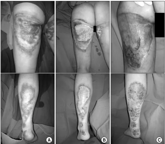 Fig. 7.  A  27-year-old  male  with  3rd  degree  burn  on  his  leg  and  buttock  (A)