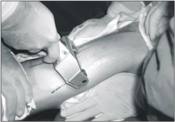 Fig.  2.  Tangential  excision  was  performed  for  burn  areas.