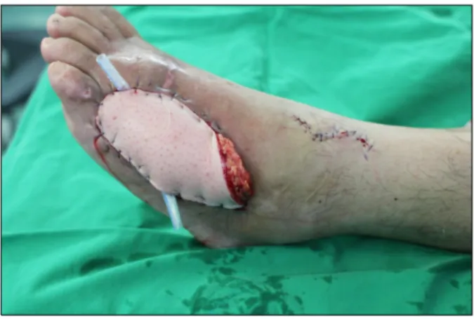 Fig. 1.  Immediately  postoperative.  A  36-years  old  male  patient  with  scalding  burn  in  using  warmed  saline  irrigation  who  underwent  anterolateral  thigh  perforator  free  flap  due  to  diabetic  foot  ulcer  on  dorsum  of  left  foot