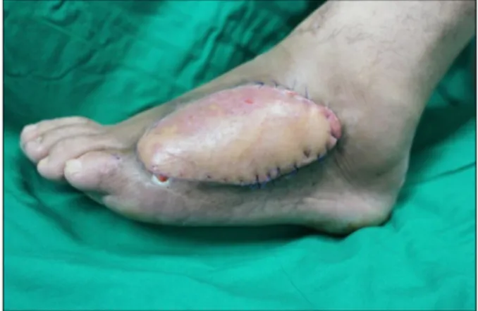 Fig. 2.  Postoperative  2  days.  A  patient  sustained  a  partial  thick- thick-ness  injury  to  the  foot.
