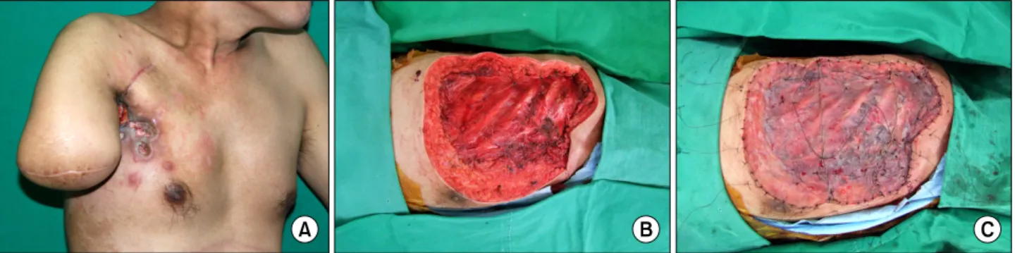 Fig. 3.  (A)  Patient  with  previous  amputation,  (B)  Forequarter  amputation,  (C)  Immediate  postoperative  photo:  the  STSG  was  perfor- perfor-med.