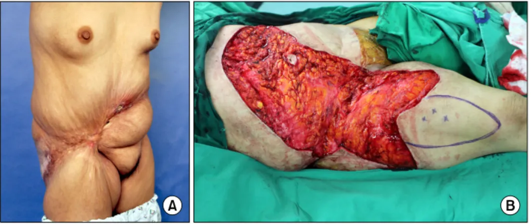 Fig. 7.  (A)  Scar  contracture  with  Marjolin's  ulcer,  (B)  Excisional  release  with  wide  excision