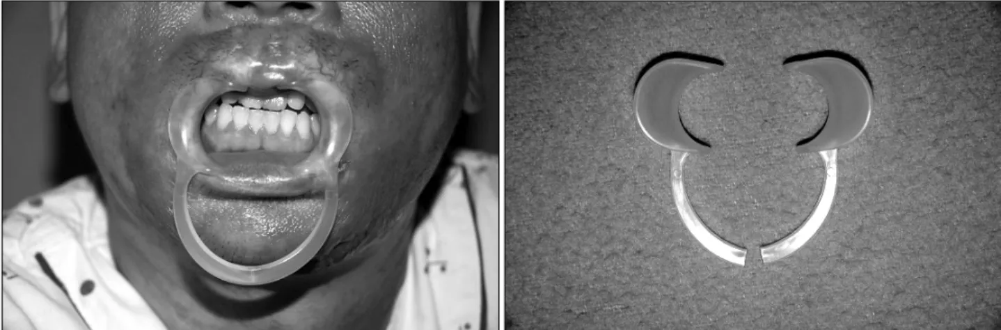 Fig. 3. Microstomia  orthosis  with  improved  internal  screw  that  have  convenient  finger  tip  bar  helping  patient  easy  to  screw  (Case  2)