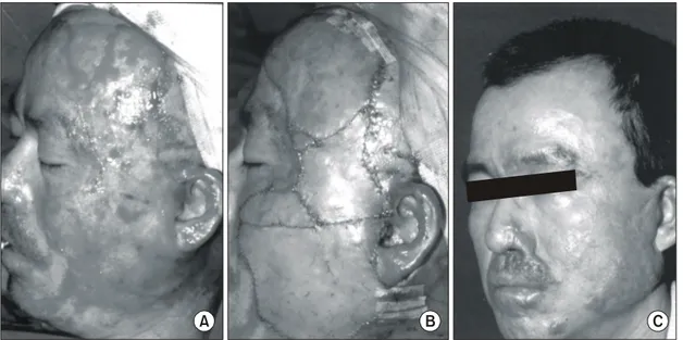 Fig.  1.  A  45  year  old  male  patient  who  had  deep  second  degree  flame  facial  burn