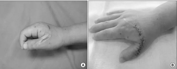 Fig. 5.  A  38-year-old  female  with  deep  2 nd   degree  burn  on  her  left  lower  leg