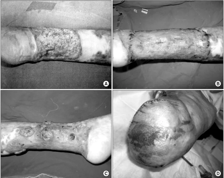 Fig. 1.  (A)  The  patients  with  Marjolin’s  ulcer  on  the  left  leg;  Pre-operative  view